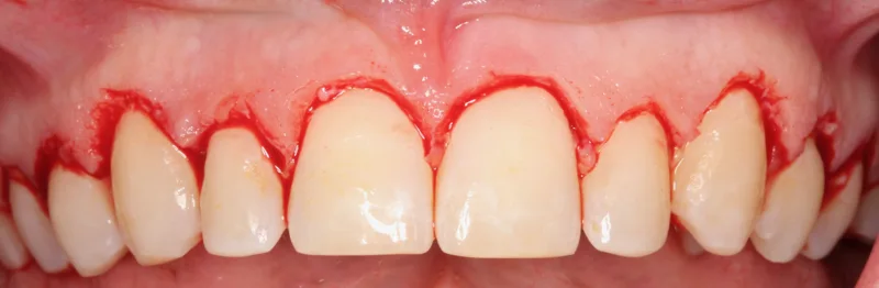 Imagen clínica del programa: Cirugía plástica periodontal